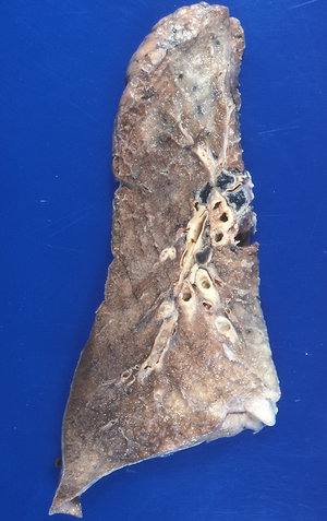 Normal formalin-perfused lung obtained at autopsy.png