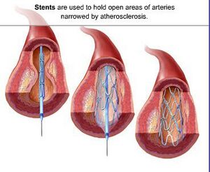 Coronary stent.jpg